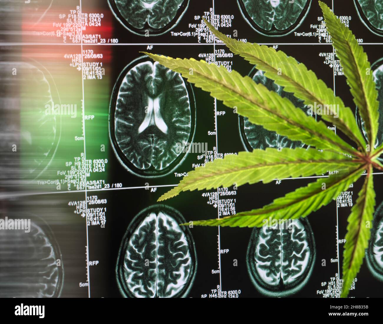 La feuille de cannabis au scan cérébral comme curation pour la démence et les alzheimers Banque D'Images
