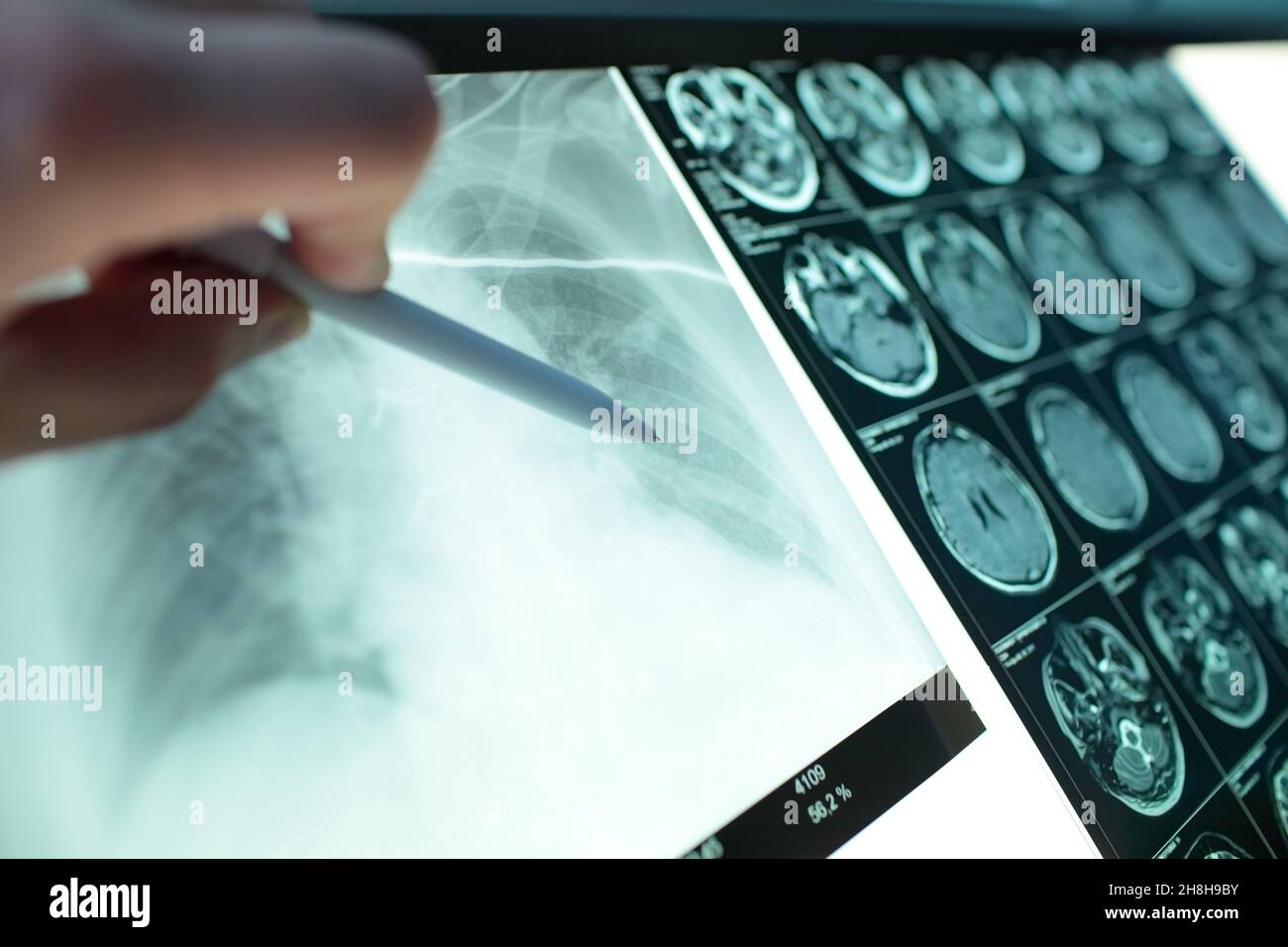 Le médecin pointe avec un stylo à l'image radiologique des poumons accrochés à un nématoscope avec une image irm de la tête. Banque D'Images