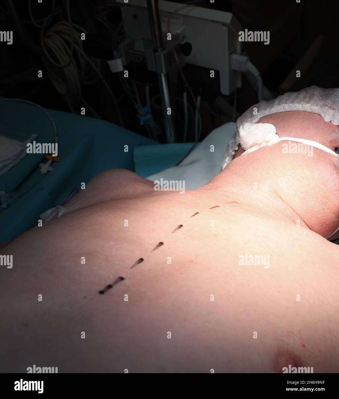 Marquage sur la peau du patient pour la chirurgie. Banque D'Images