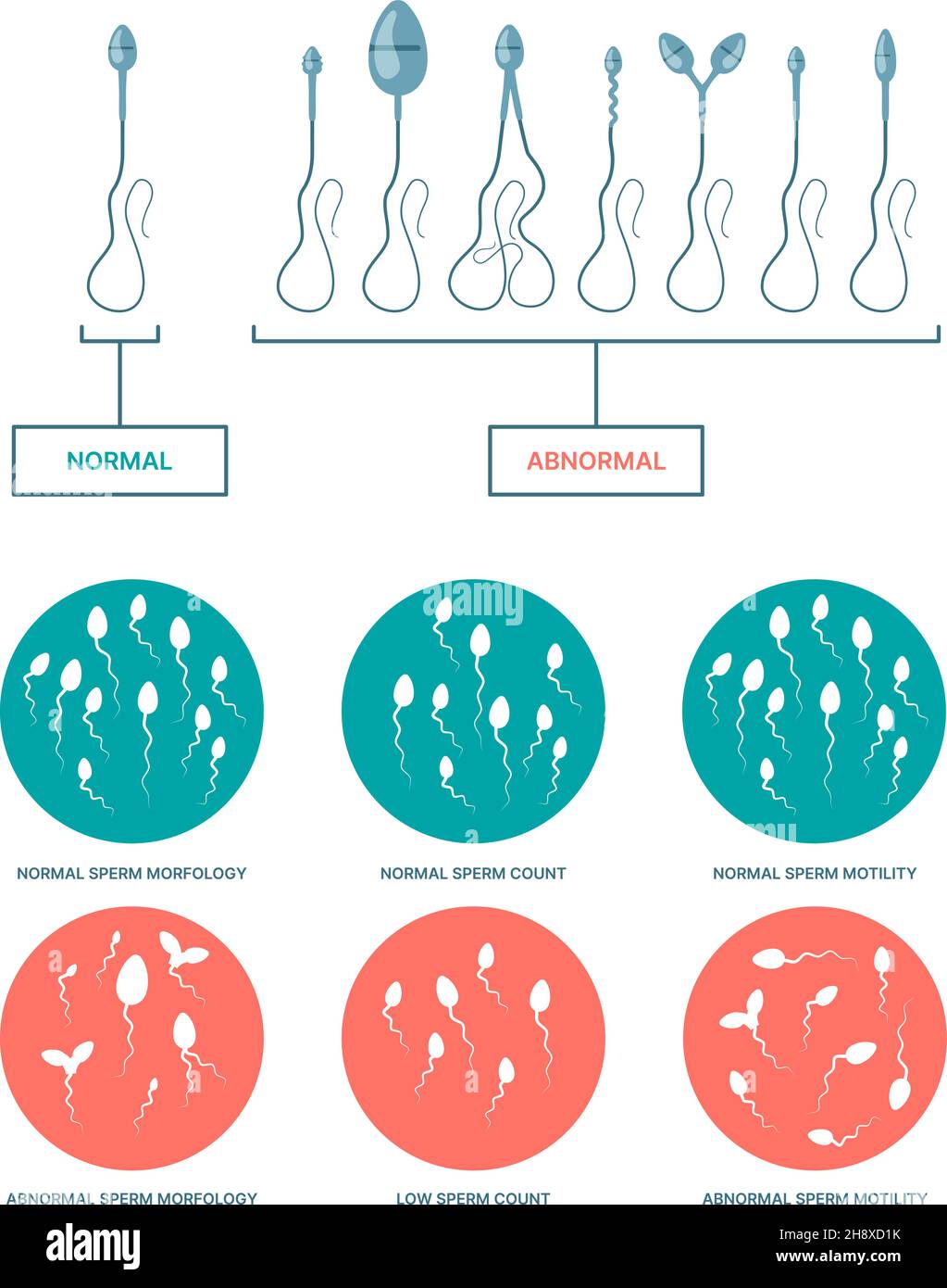 Spermogram.Infographie médicale avec le plan de naissance des spermatozoïdes sains et endommagés processus d'ovulation vecteur garish modèles plats Illustration de Vecteur