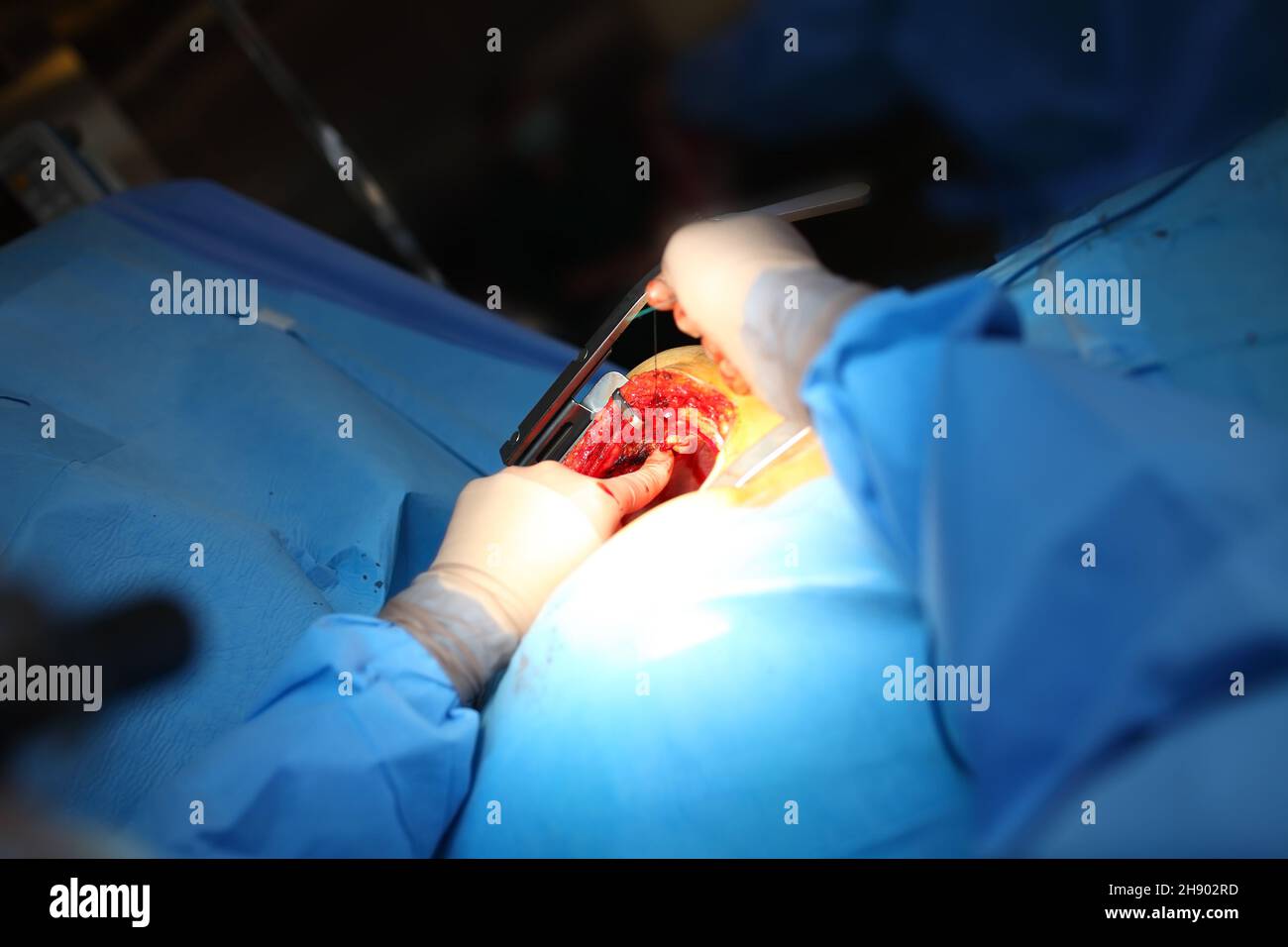 Chirurgien chargé de suturer la plaie dans la salle d'opération. Banque D'Images