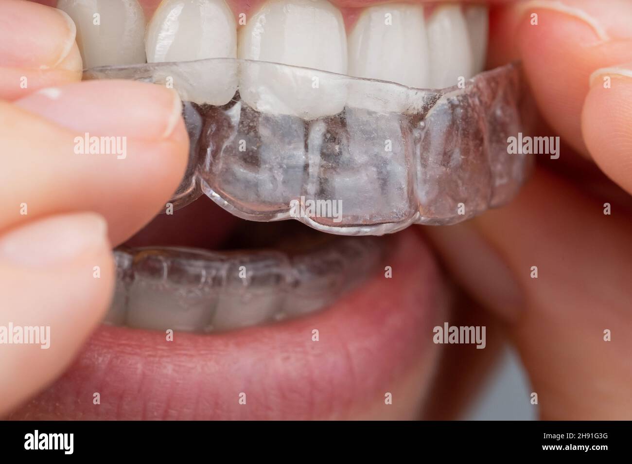 Femme caucasienne mettant sur des aligneurs.Dispositif de lissage des dents orthodontiques. Banque D'Images