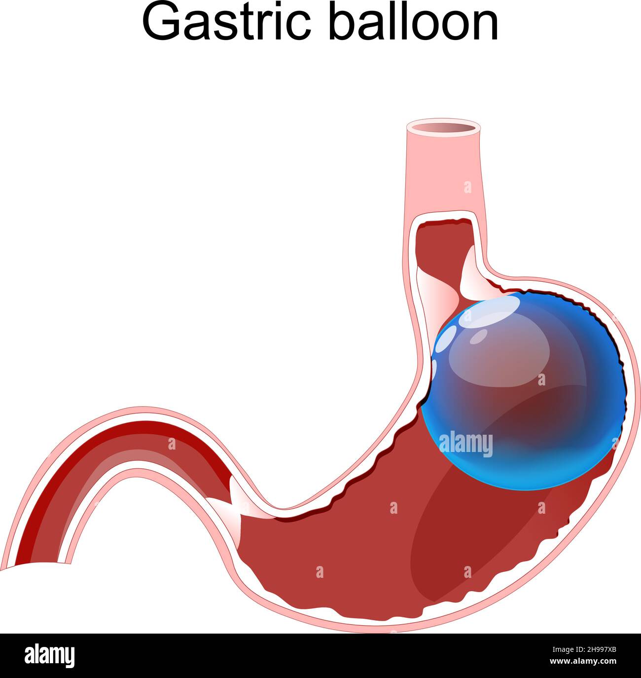 Ballon gastrique.Ballon intragastrique à l'intérieur d'un estomac. Perte de poids. Chirurgie intragastrique.Schéma vectoriel à usage médical Illustration de Vecteur