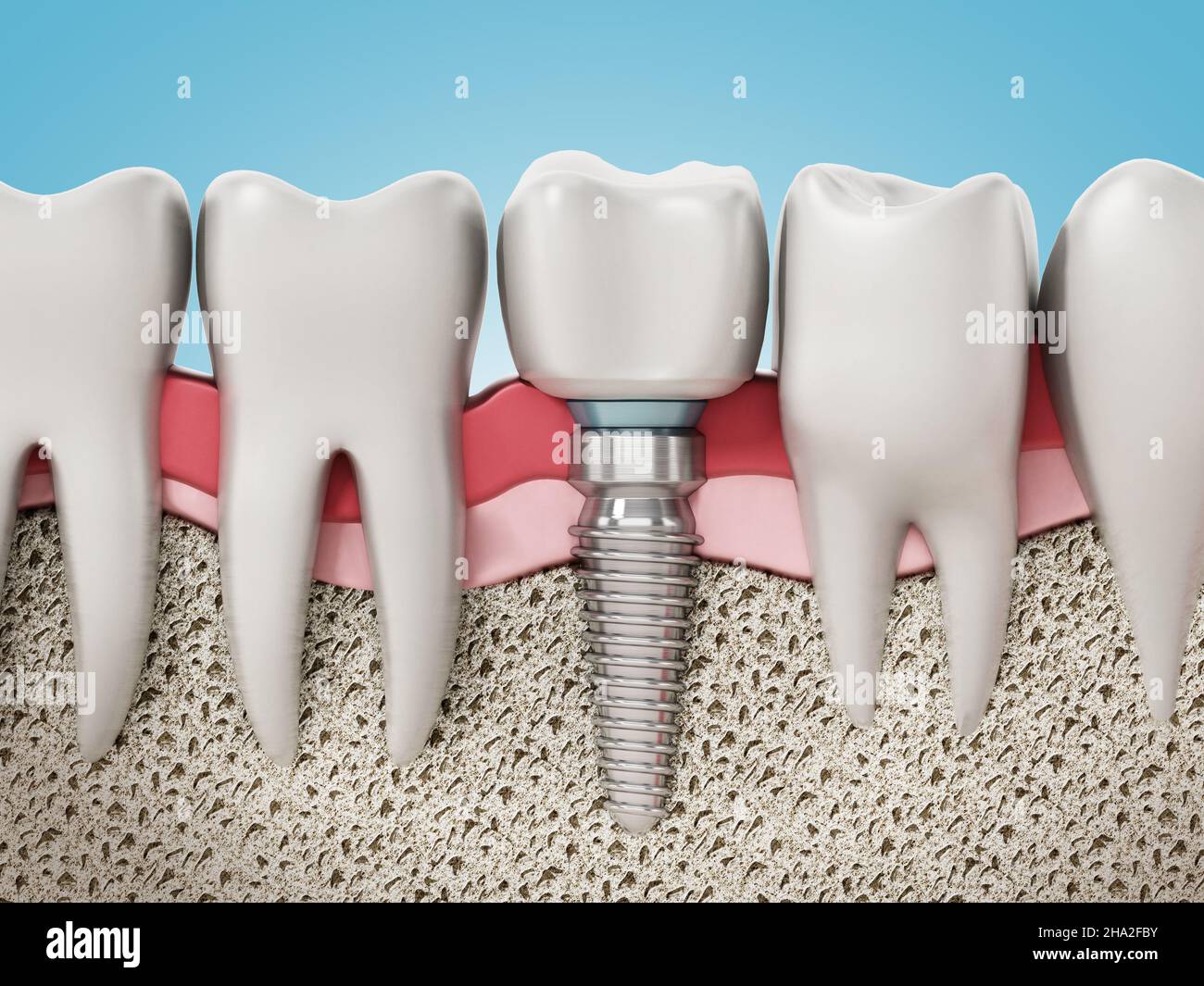 3D rendu de l'implant dentaire montrant la gomme de la mâchoire et les couches osseuses.3D illustration. Banque D'Images