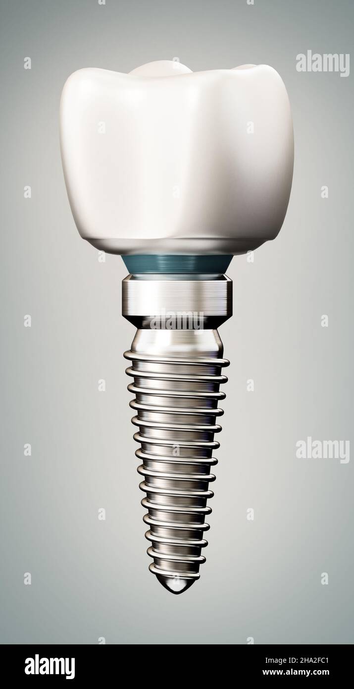 3D rendu de l'implant dentaire.3D illustration. Banque D'Images