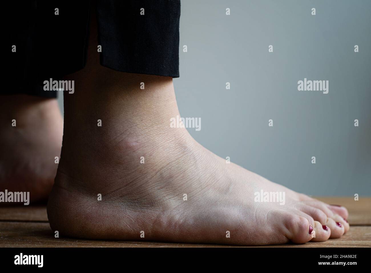 Gros plan d'une personne avec une cheville entortillée et un pied qui est encore un peu enflé et meurtri après une blessure. Banque D'Images