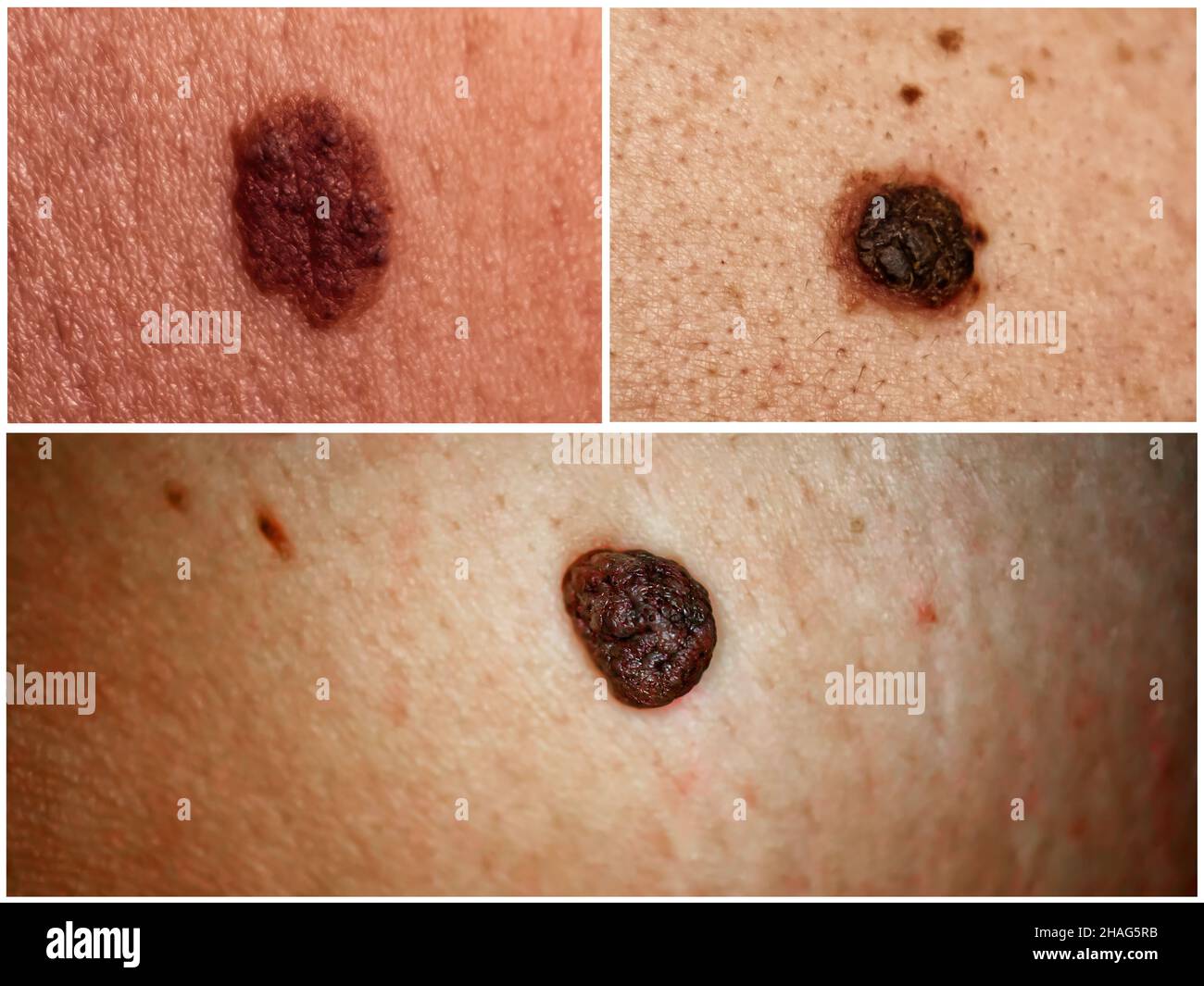 Collage de photos de différents grains de beauté sur la peau humaine. Banque D'Images