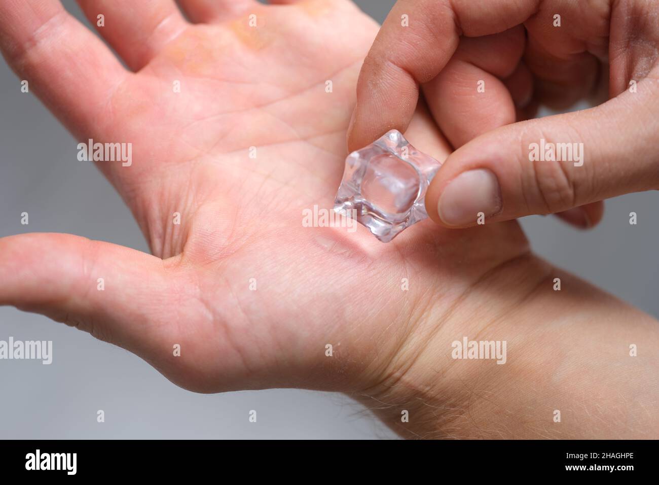 La main d'un homme frotte les callosités avec un cube de glace Banque D'Images