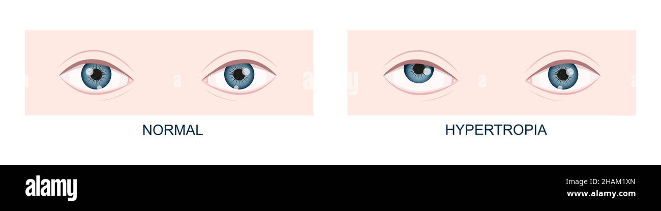 Hypertropie.Strabisme vertical avant et après la chirurgie.Yeux humains en bonne santé et avec position du regard vers le haut.Double vision.Illustration de dessin animé vectoriel. Illustration de Vecteur Hypertropie.Strabisme vertical avant et après la chirurgie.Yeux humains en bonne santé et avec position du regard vers le haut.Double vision.Illustration de dessin animé vectoriel. Illustration de Vecteur