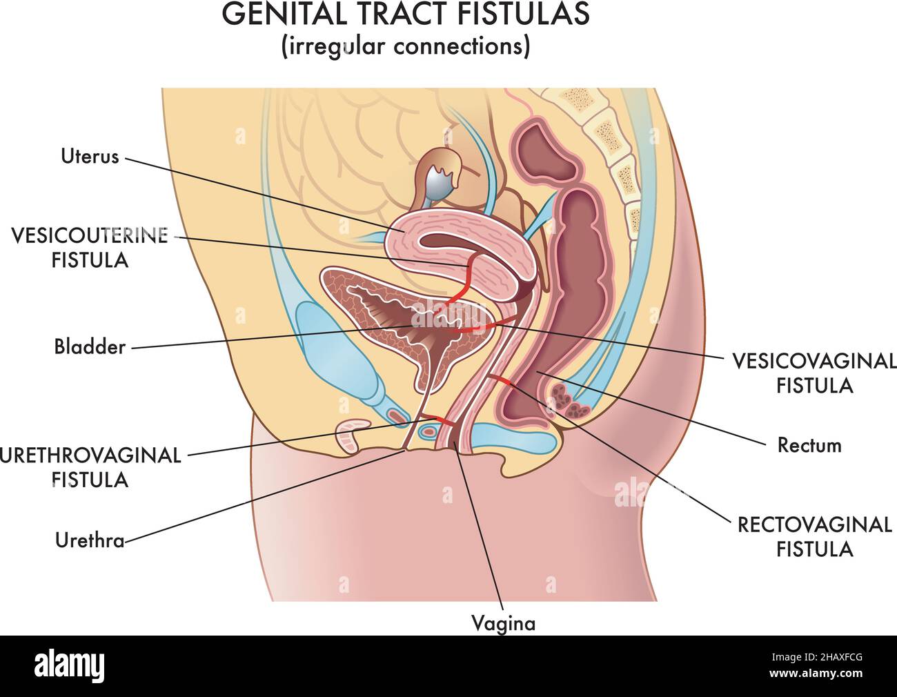 Illustration médicale des connexions irrégulières appelées fistules qui peuvent être trouvées dans le tractus génital de la femme. Illustration de Vecteur