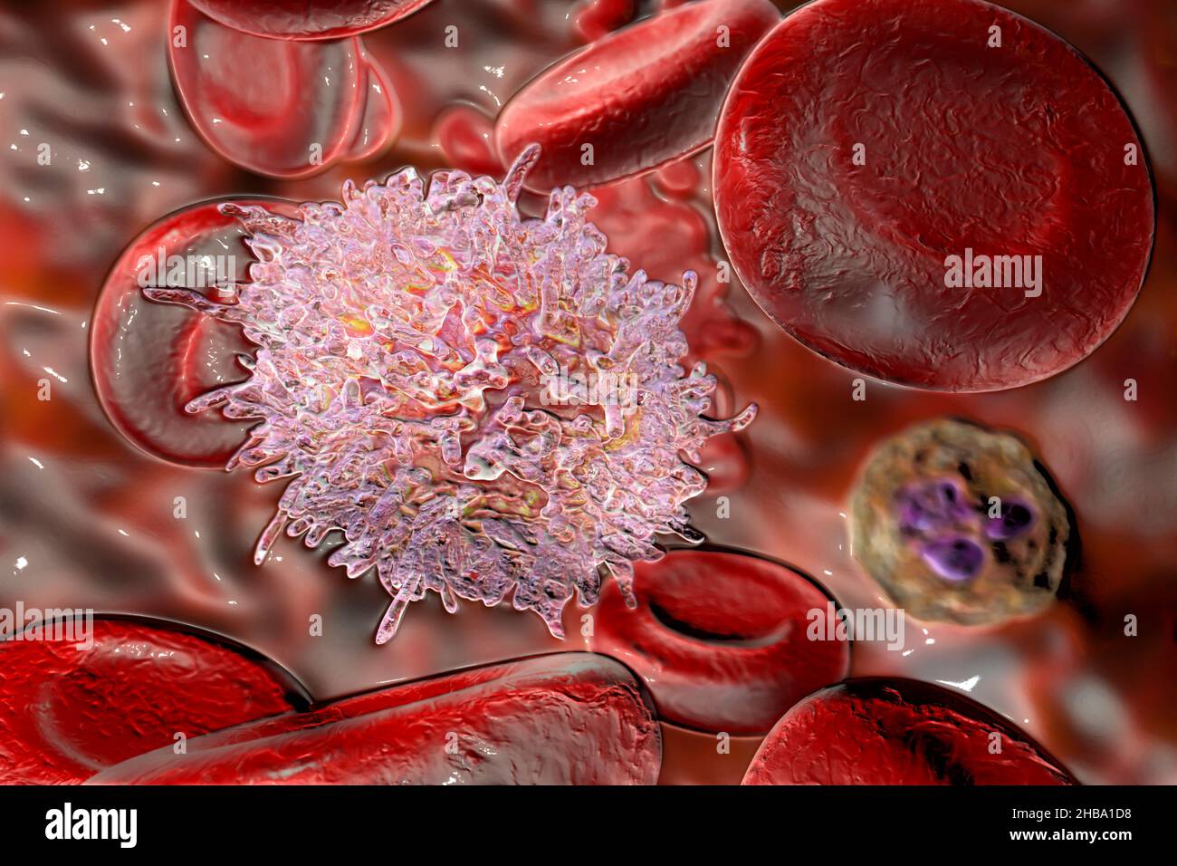 Leucémie à cellules poilues.Illustration de globules blancs anormaux  (lymphocytes B) provenant d'un patient atteint d'une leucémie à cellules  poilues.Ces cellules présentent des projections cytoplasmiques  caractéristiques ressemblant à des cheveux et ...