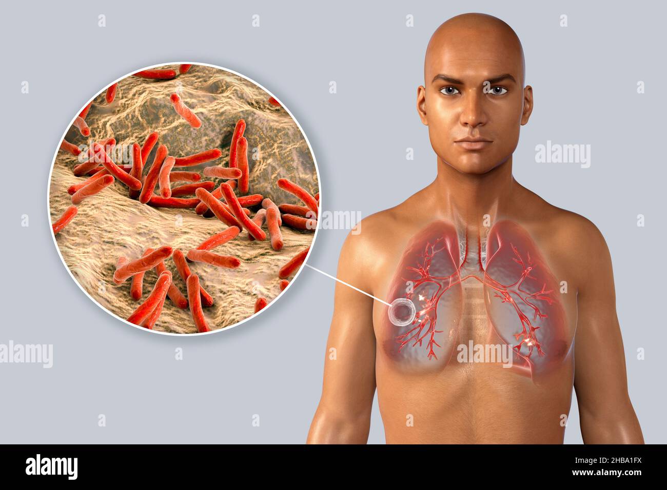 Illustration de la tuberculose pulmonaire fibreuse caverneuse avec une vue rapprochée de la bactérie Mycobacterium tuberculosis, l'agent responsable de la tuberculose.Il y a une caverne (cavité) dans le poumon droit avec une couche fibreuse bien formée dans sa paroi. Banque D'Images