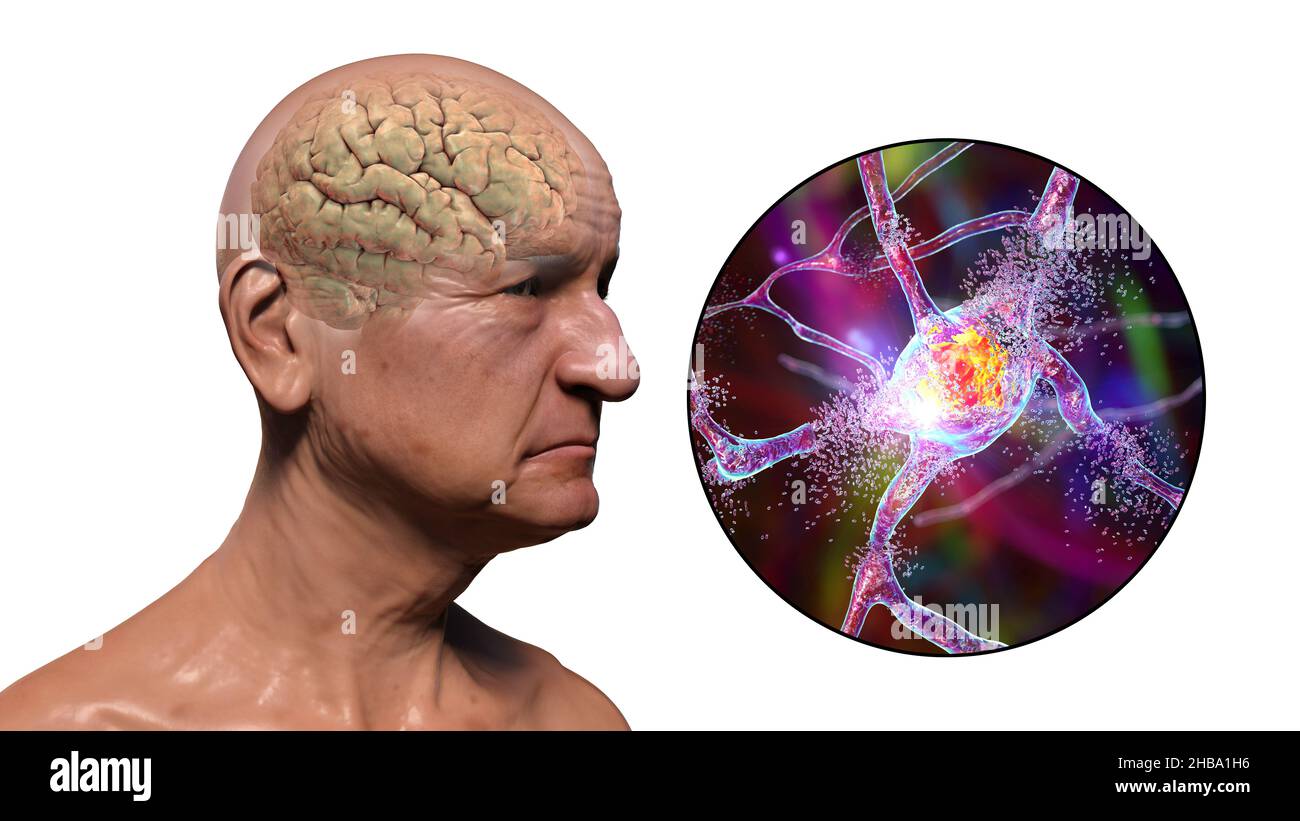 La démence et la maladie d'Alzheimer.Illustration informatique ...