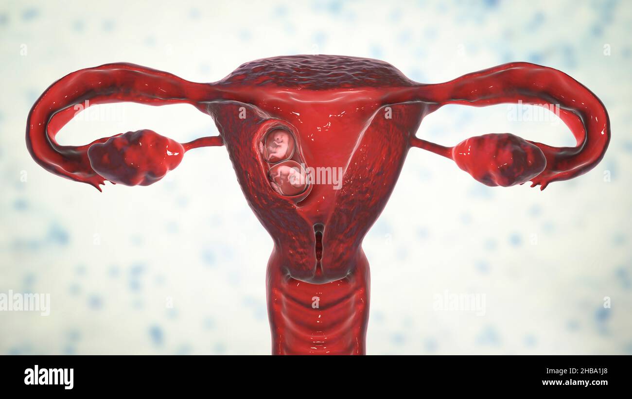 Grossesse multiple, illustration.Jumeaux monozygotes dans l'utérus partageant le même placenta à la semaine 8. Banque D'Images