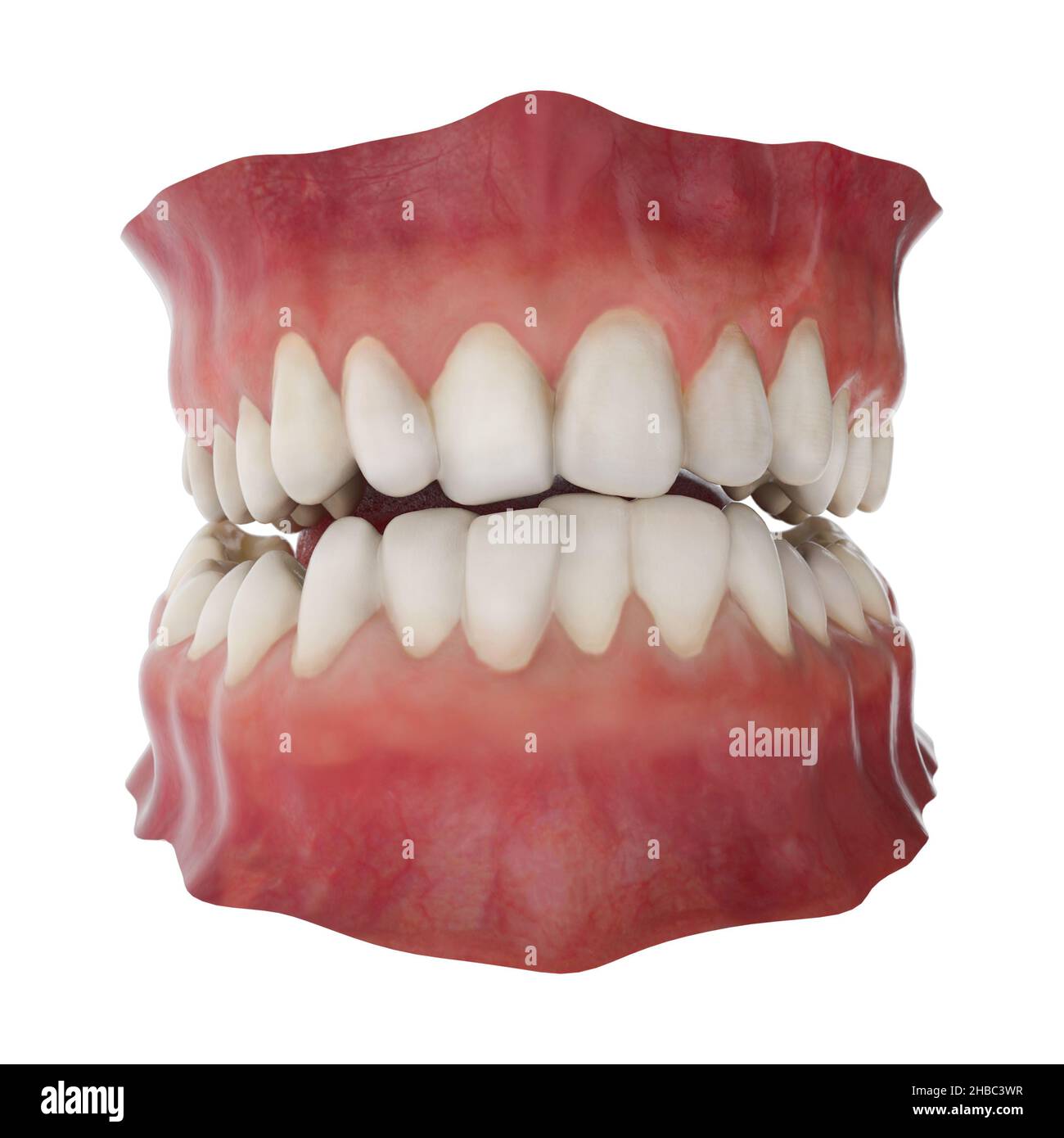 Mâchoire présentant une position de dents anormale.Concept de traitement orthodontique.Illustration réaliste 3D Banque D'Images