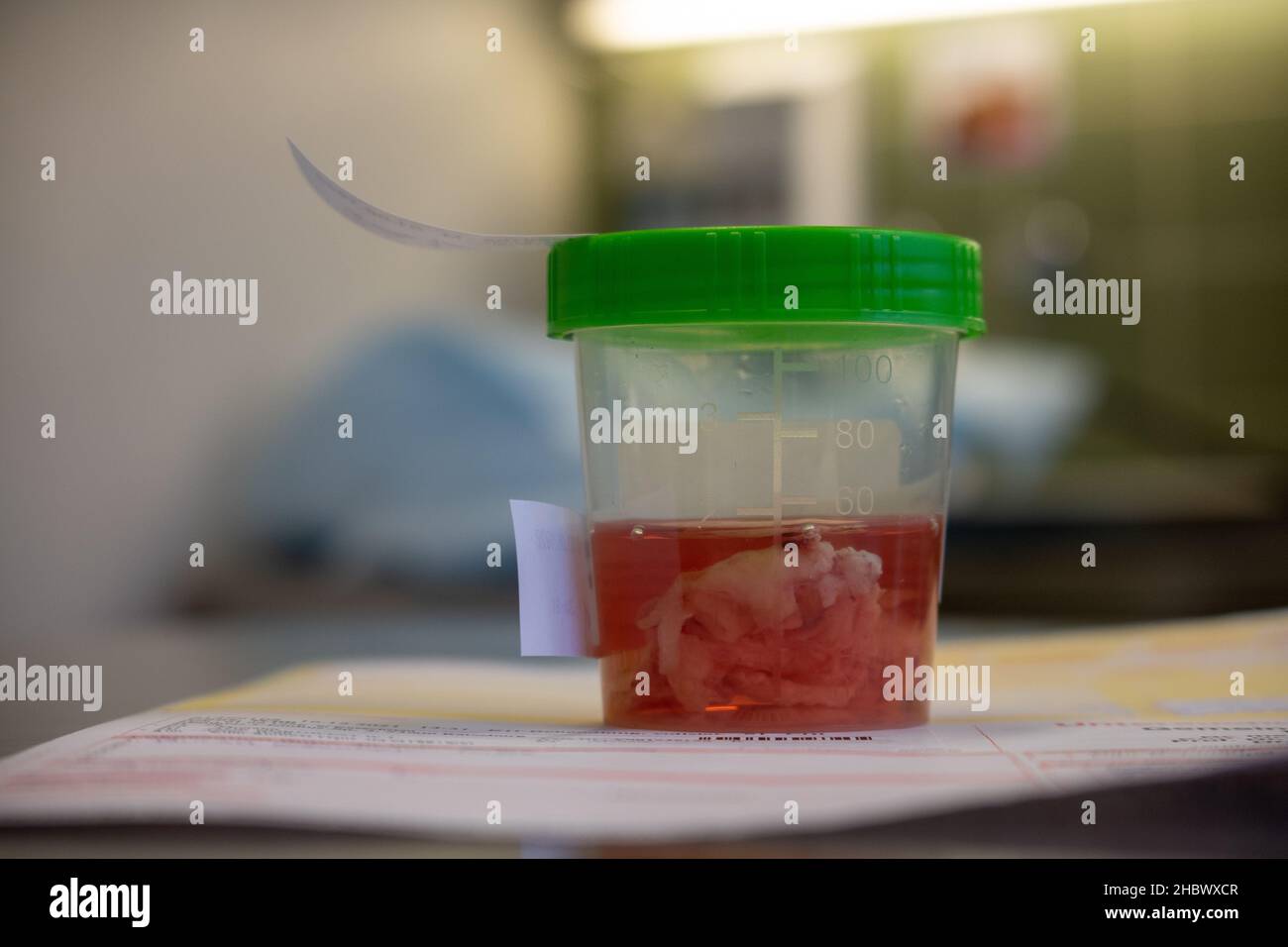 un échantillon de tissu est placé dans une cupule remplie de formol après une opération Banque D'Images