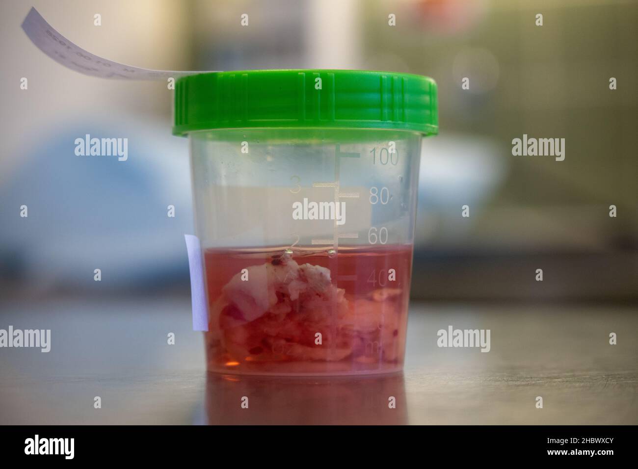 un échantillon de tissu est placé dans une cupule remplie de formol après une opération Banque D'Images