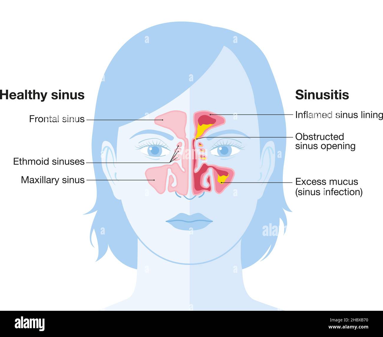 Illustration vectorielle montrant un sinus et une sinusite sains avec une doublure enflammée, une ouverture du sinus obstruée, un adénoïde et un mucus en excès Banque D'Images