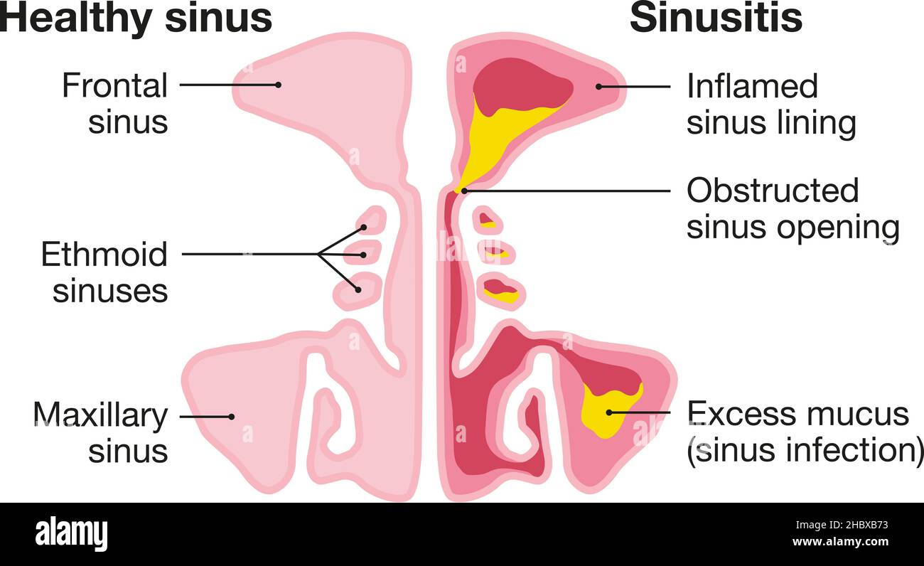 Illustration vectorielle montrant un sinus et une sinusite sains avec une doublure enflammée, une ouverture du sinus obstruée, un adénoïde et un mucus en excès Banque D'Images