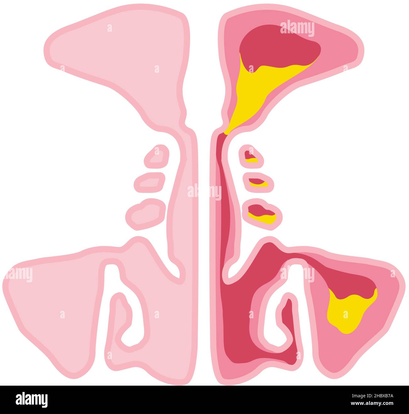 Illustration vectorielle montrant un sinus et une sinusite sains avec une doublure enflammée, une ouverture du sinus obstruée, un adénoïde et un mucus en excès Banque D'Images