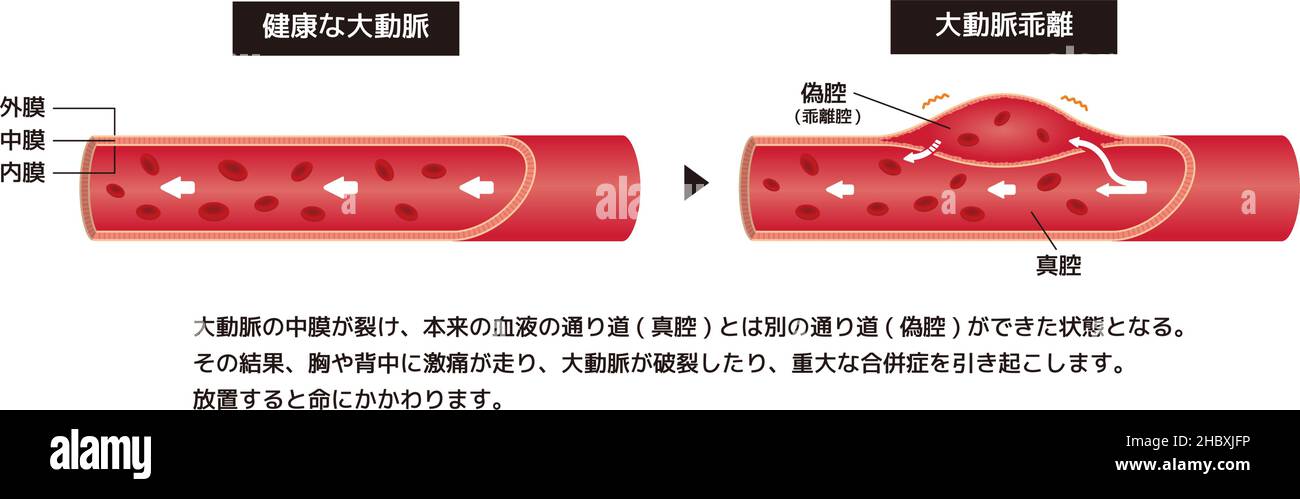 Illustration de comparaison de l'aorte normale et de la dissection aortique (japonais) Illustration de Vecteur