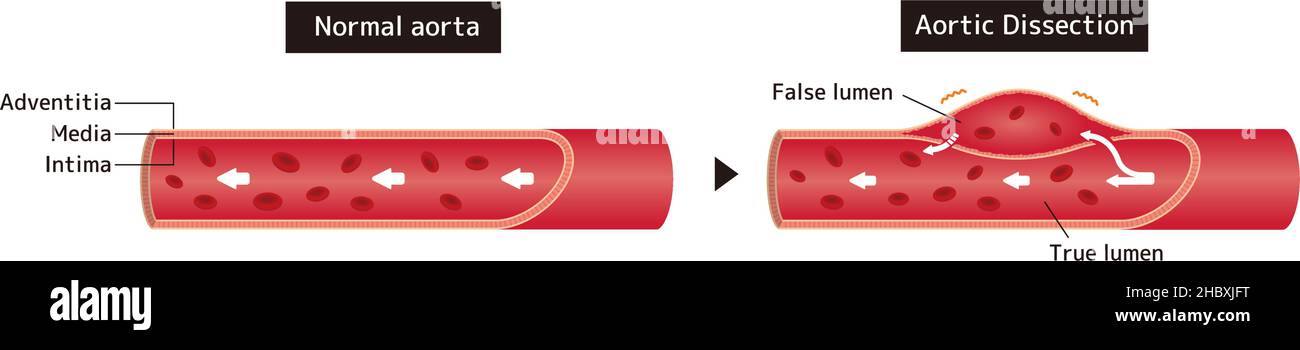 Illustration de comparaison de l'aorte normale et de la dissection aortique Illustration de Vecteur