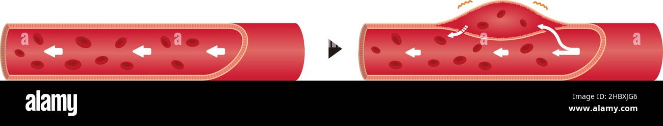 Illustration de comparaison de l'aorte normale et de la dissection aortique (pas de texte) Illustration de Vecteur