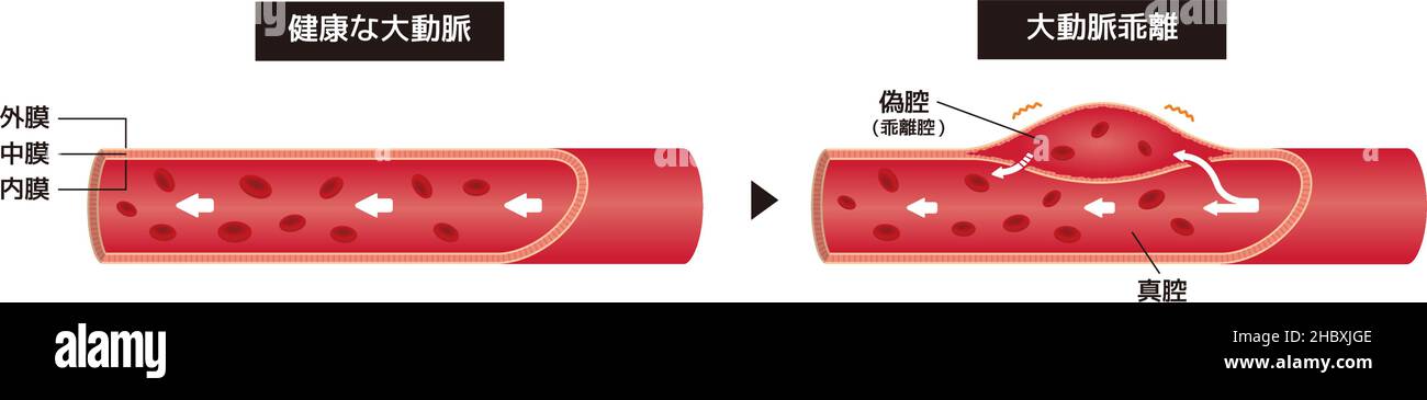 Illustration de comparaison de l'aorte normale et de la dissection aortique (japonais) Illustration de Vecteur