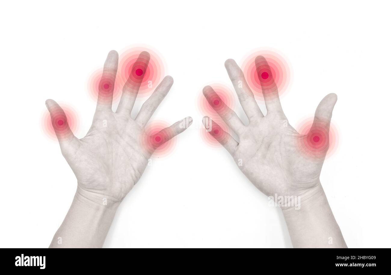 Inflammation des articulations des doigts.Concept et idée de l'arthrite rhumatismale, la polyarthrite imgratante ou arthralgie. Banque D'Images