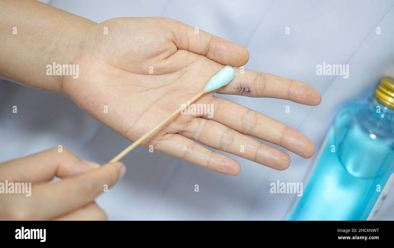 Une femme utilise une boule de coton pour essuyer l'alcool autour de la plaie sur la suture du doigt afin de tuer les germes. Banque D'Images