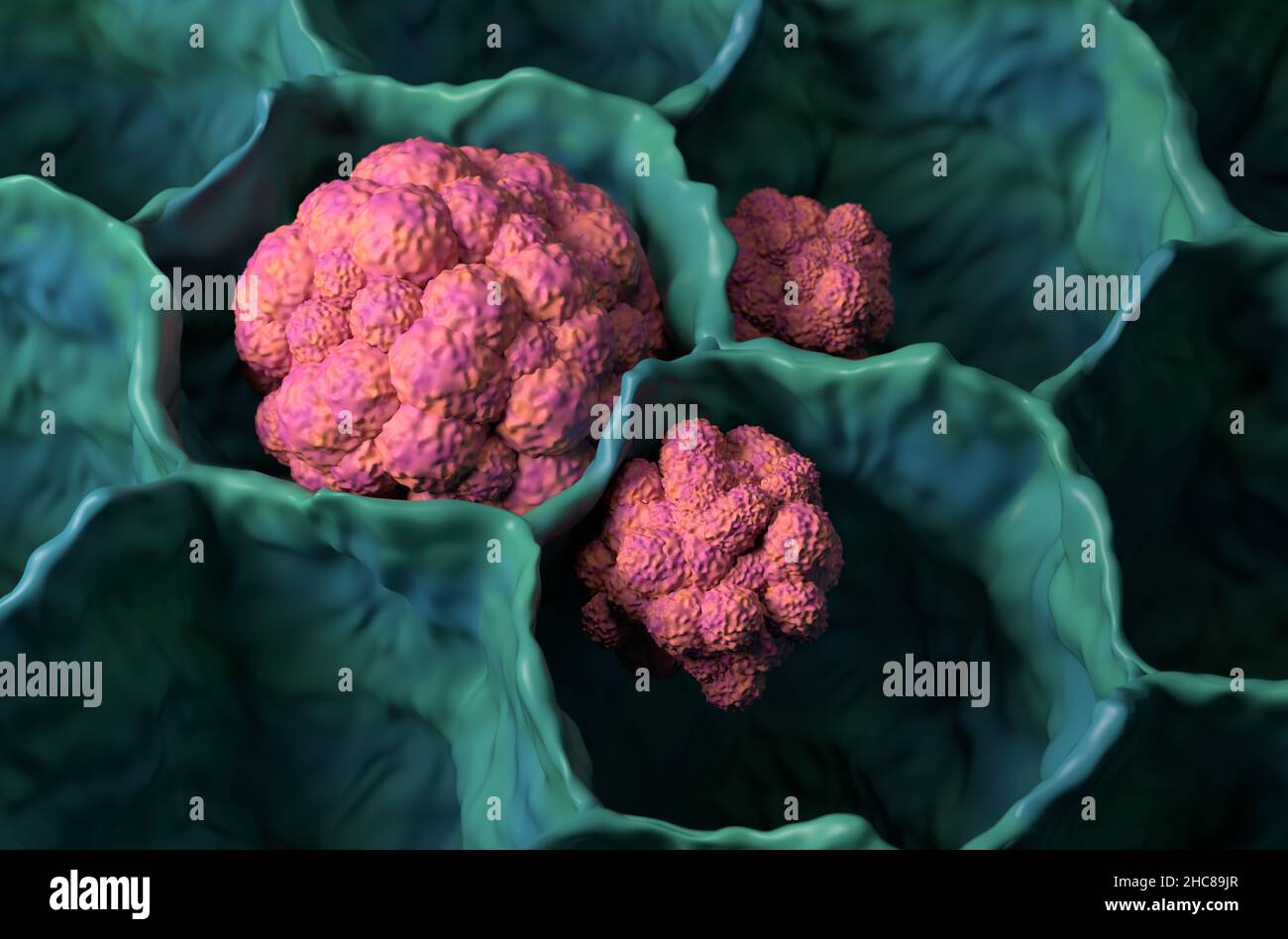 Cancer du poumon microbiologie tumorale 3D illustration vue rapprochée Banque D'Images