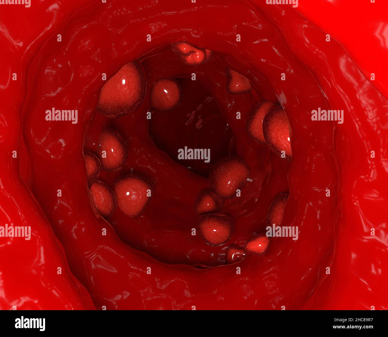 Petites tumeurs sur la paroi du côlon dans le cancer colorectal 3D illustration Banque D'Images