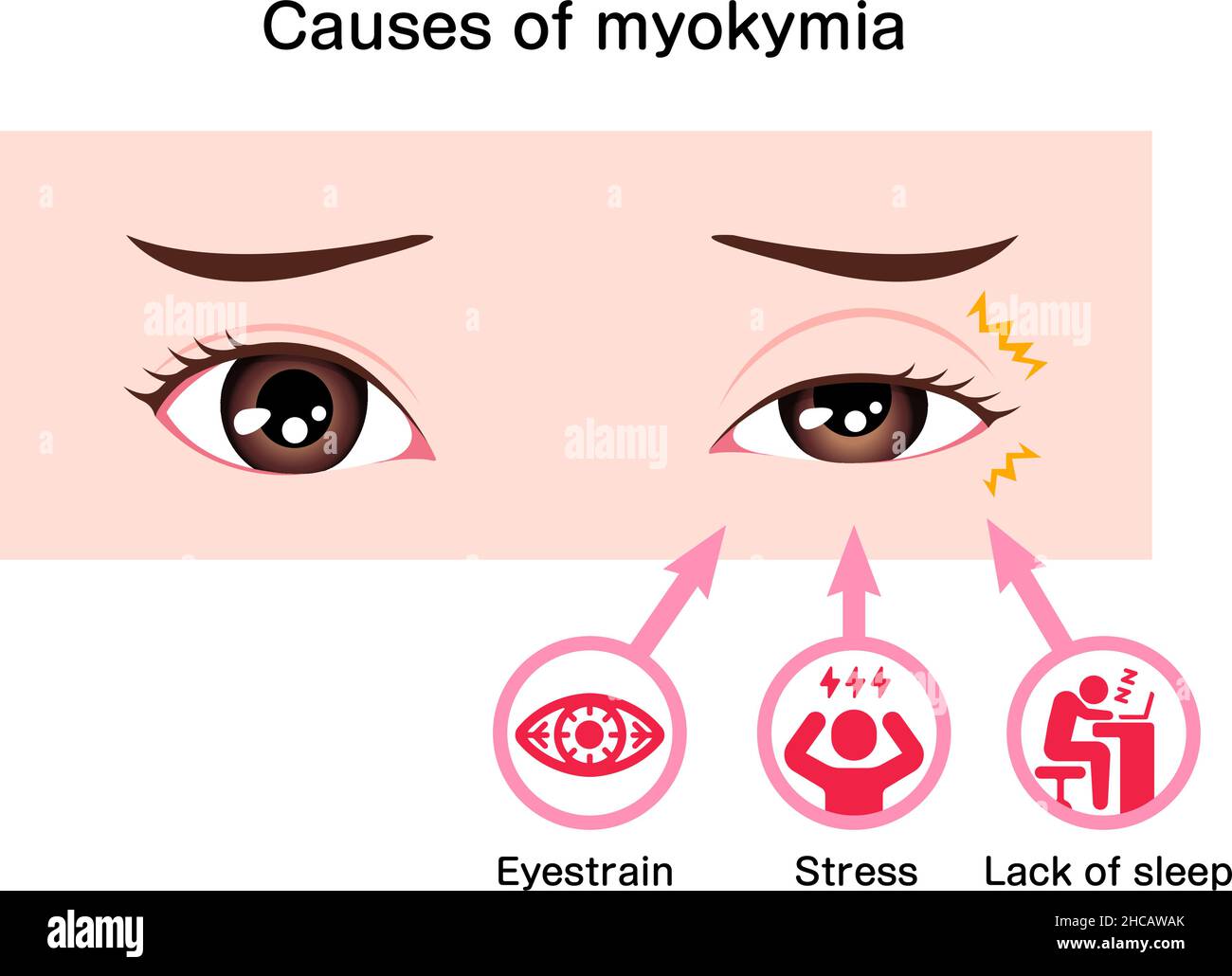 Causes de l'illustration du vecteur myokymie (contraction de la paupière ou tique) Illustration de Vecteur