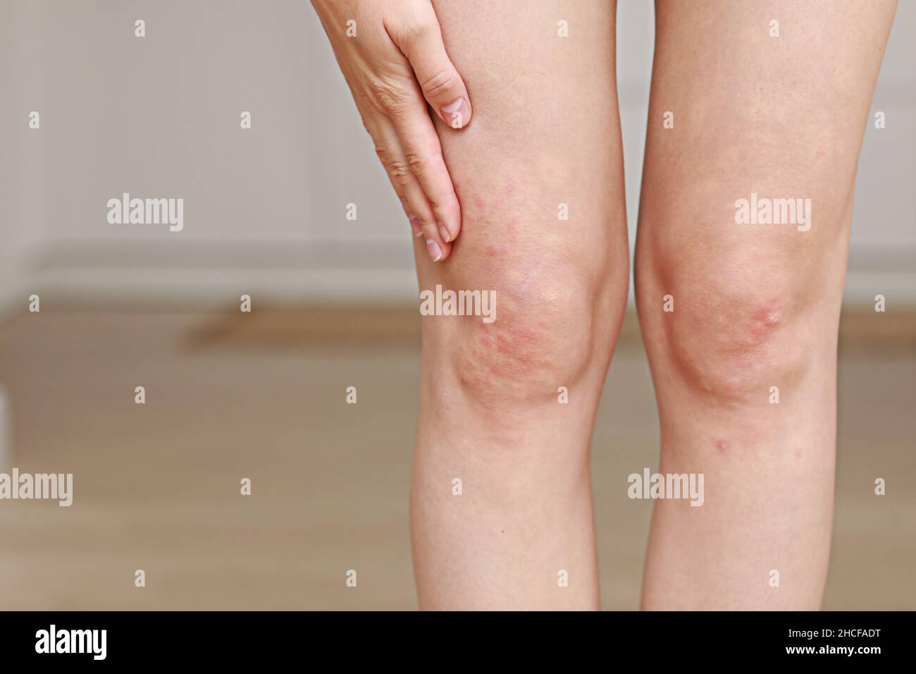 allergies cutanées, jambes peau femmes.Gros plan de pustules ...