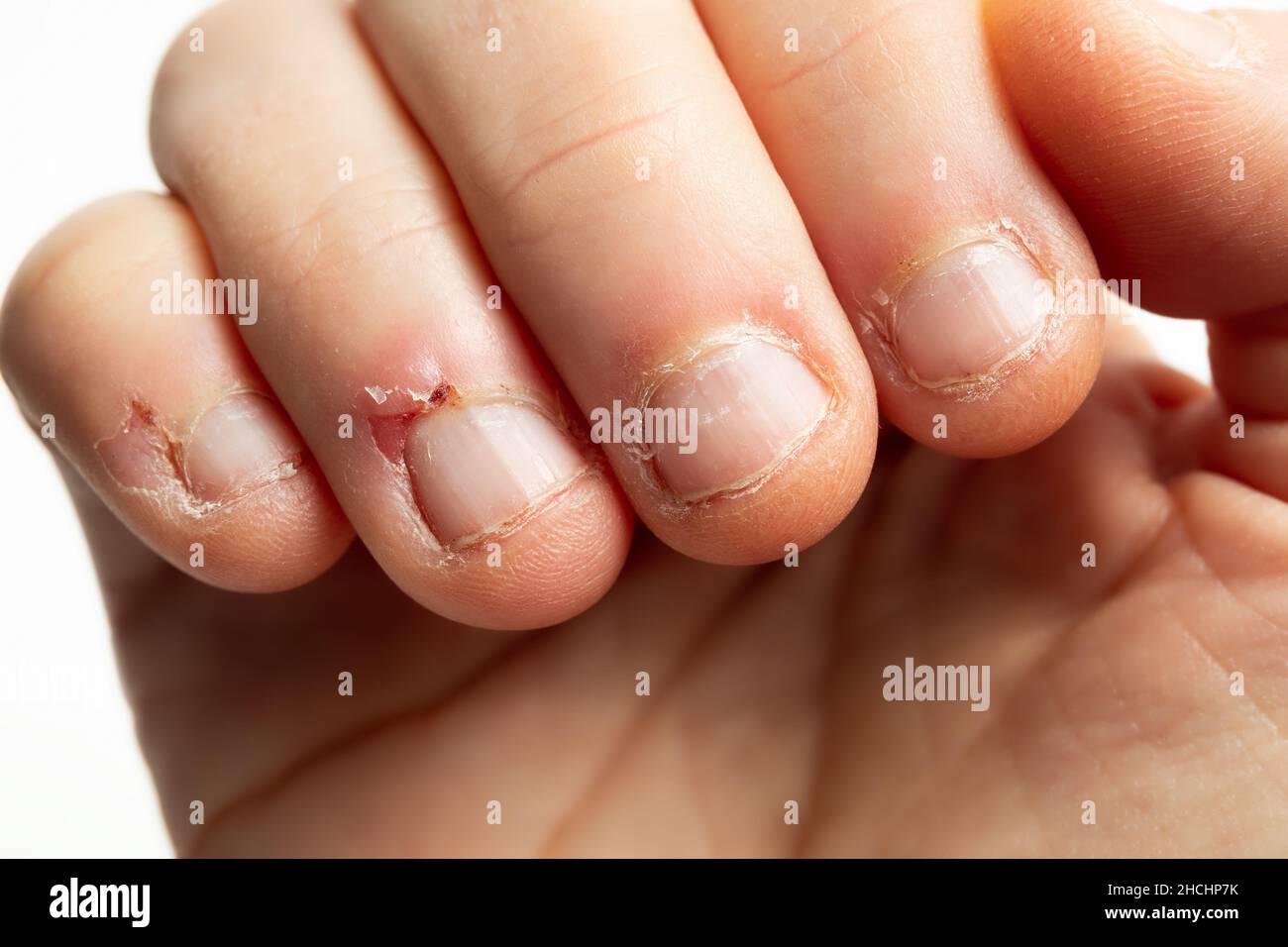 Doigts avec signes de morsure des ongles.Gros plan de la main femelle adulte avec des ongles mâchés et de nombreuses petites blessures sur la peau environnante.Signes de la mentalement Banque D'Images
