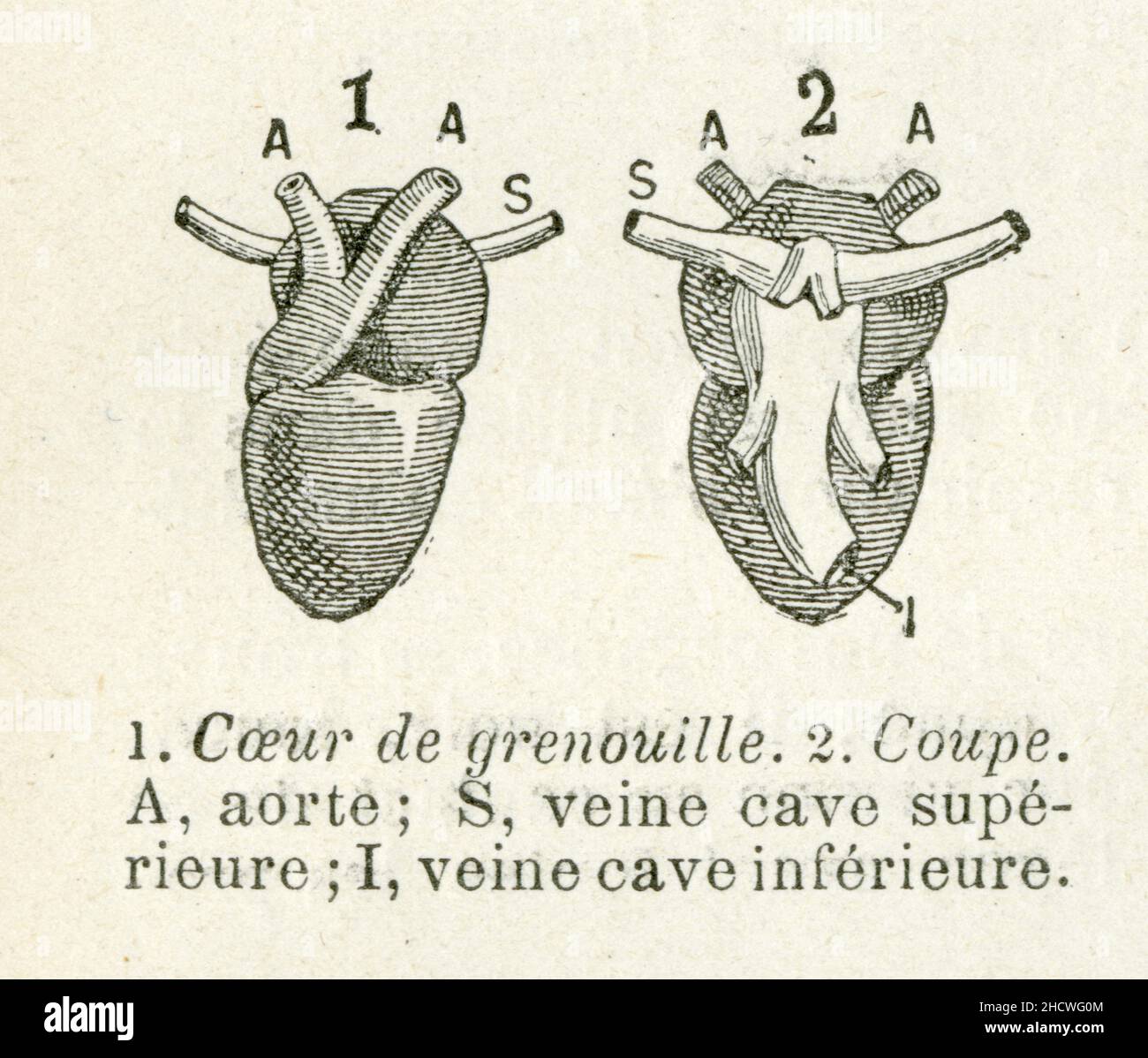 compression veine cave inférieure symptôme