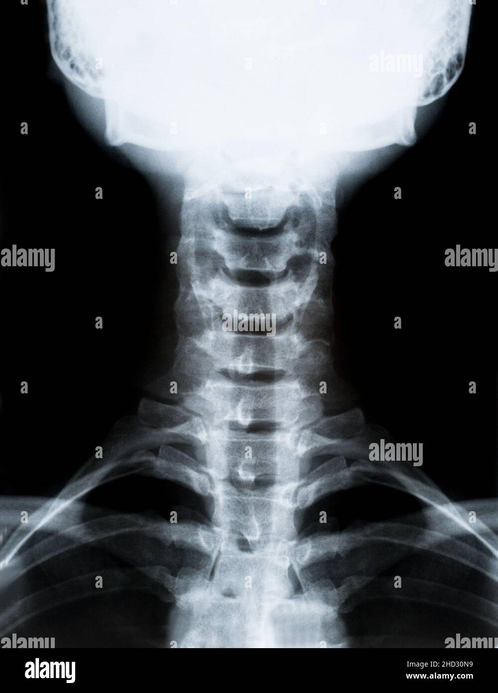 Image radiographique de la colonne cervicale du cou isolée sur fond noir Banque D'Images