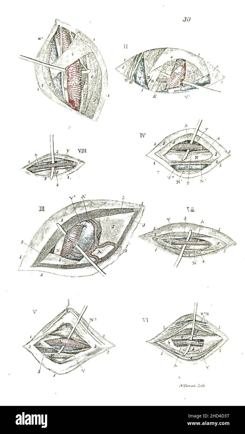 Une illustration en noir et blanc du processus d'une opération dans un manuel d'anatomie du XIXe siècle Banque D'Images