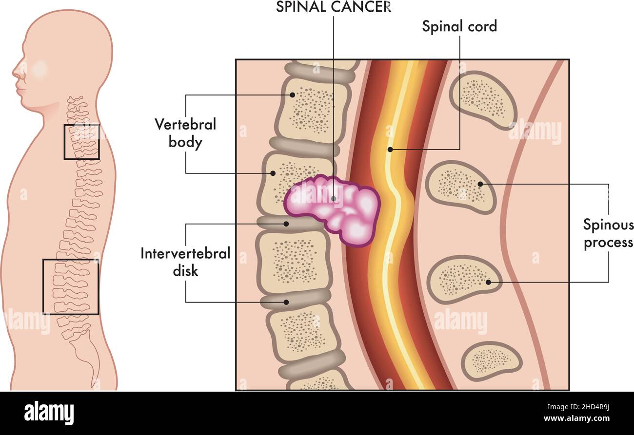 Illustration médicale des symptômes du cancer de la colonne vertébrale et de l'endroit probable où il se développe. Avec des annotations. Illustration de Vecteur