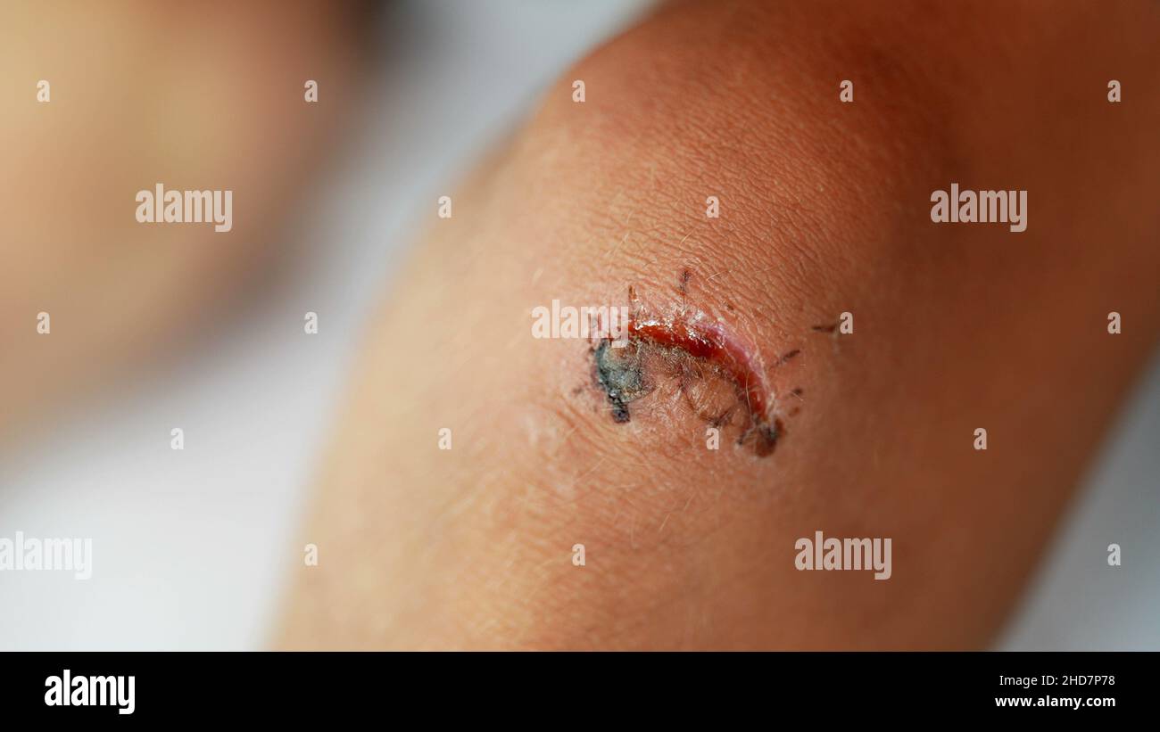 Blessure au genou d'un enfant après une chute avec des points de suture Banque D'Images
