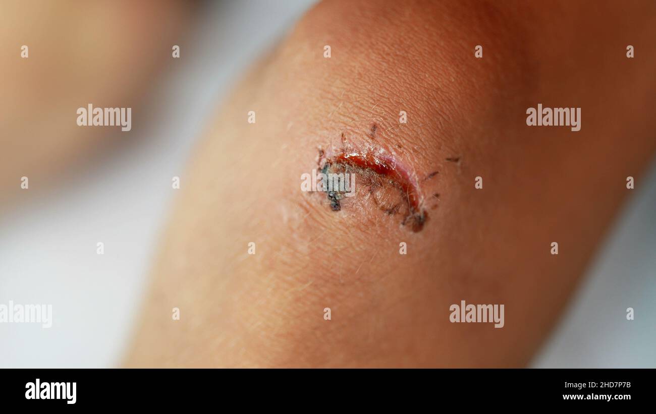 Blessure au genou d'un enfant après une chute avec des points de suture Banque D'Images