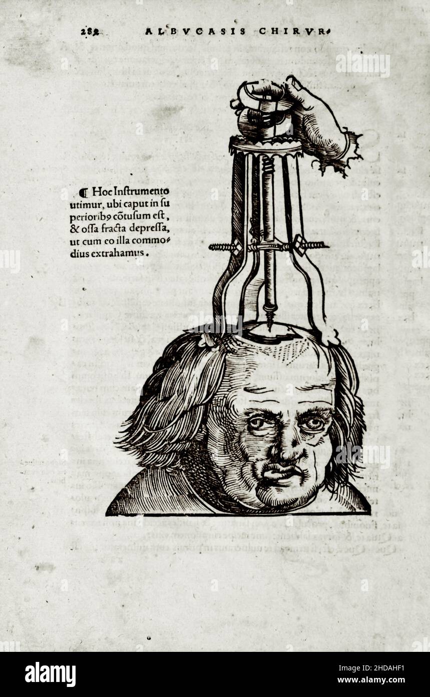 L'illustration au 16th siècle de la chirurgie et des opérations chirurgicales au Moyen-âge: La trépanation du crâne.Des livres médiévaux d'Octavius Ho Banque D'Images