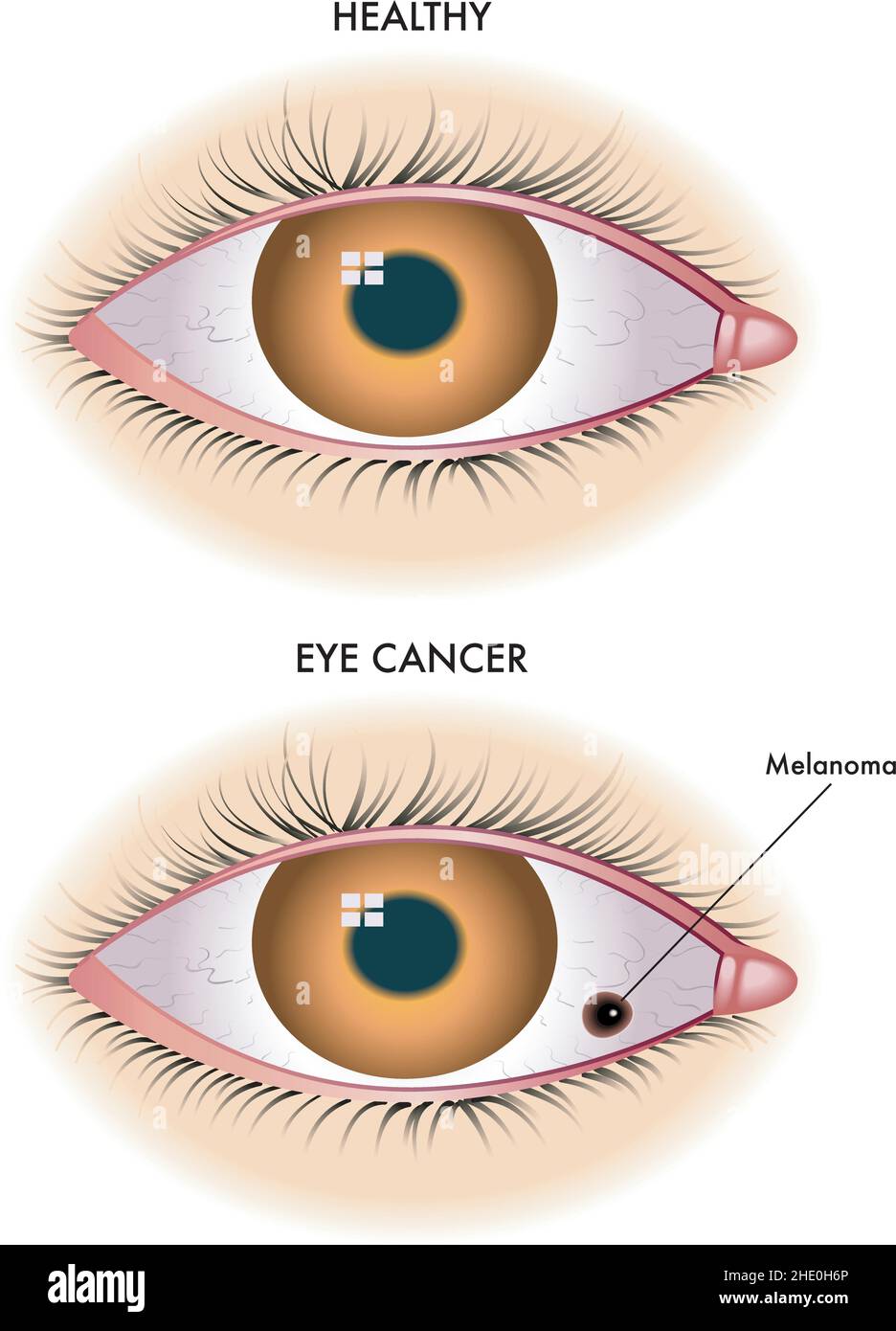 L'illustration médicale montre un œil sain par rapport à un œil affecté par le mélanome. Illustration de Vecteur