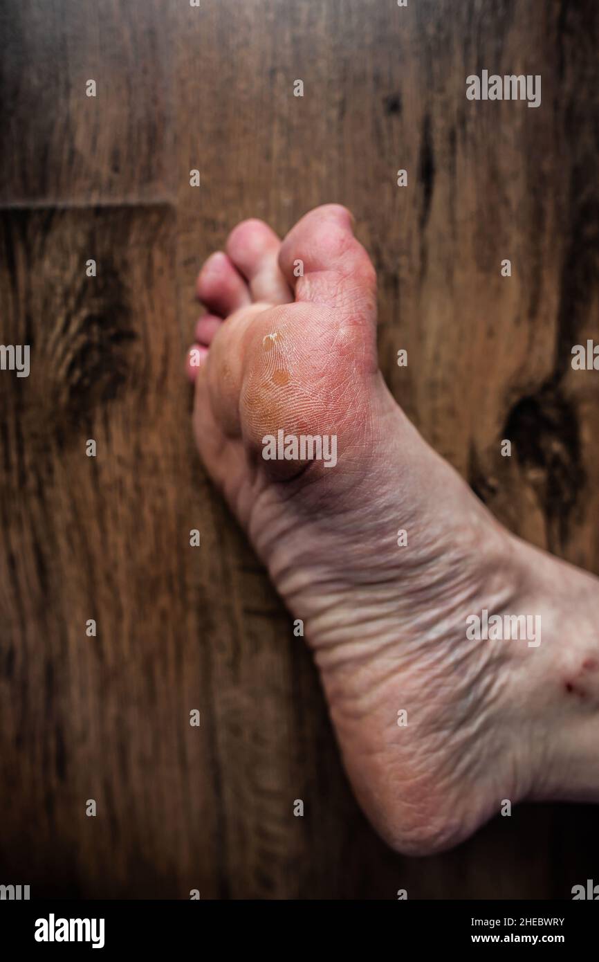 Pied de personne souffrant du syndrome de Raynaud et d