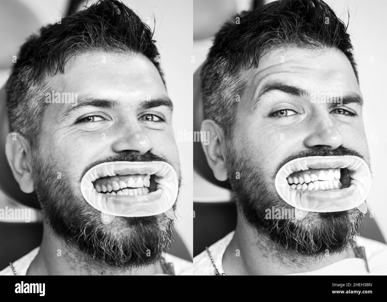Dents blanches - avant et après concept.Gros plan des dents d'homme avant et après le blanchiment.Résultat du blanchiment des dents.Sourire parfait après Banque D'Images