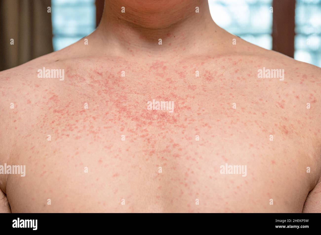 Dermatite éruption maladie virale avec immunodéficit sur le corps de jeune adulte asiatique, gratter avec la démangeaison, virus de la rougeole, l'exhymne viral Banque D'Images Dermatite éruption maladie virale avec immunodéficit sur le corps de jeune adulte asiatique, gratter avec la démangeaison, virus de la rougeole, l'exhymne viral Banque D'Images