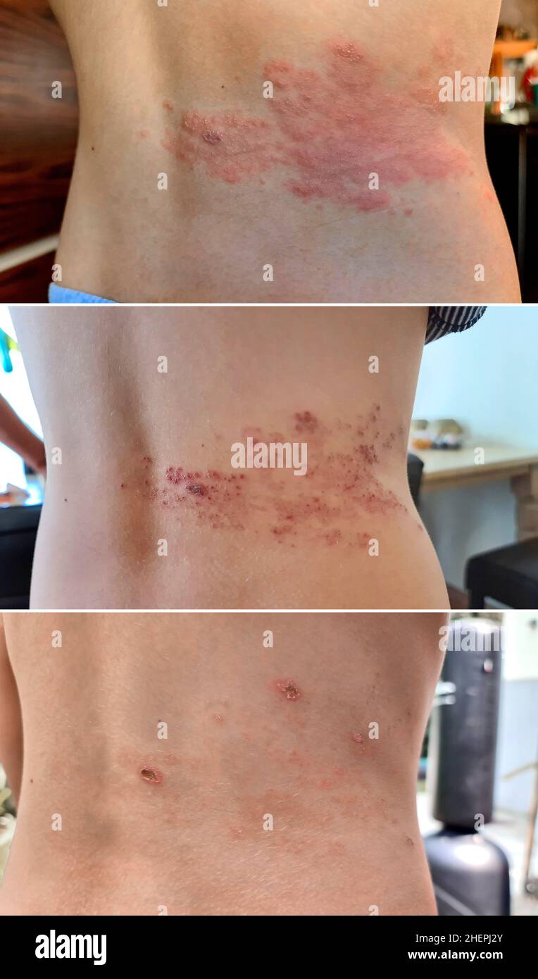 développement d'une éruption de bardeaux à l'arrière Banque D'Images développement d'une éruption de bardeaux à l'arrière Banque D'Images