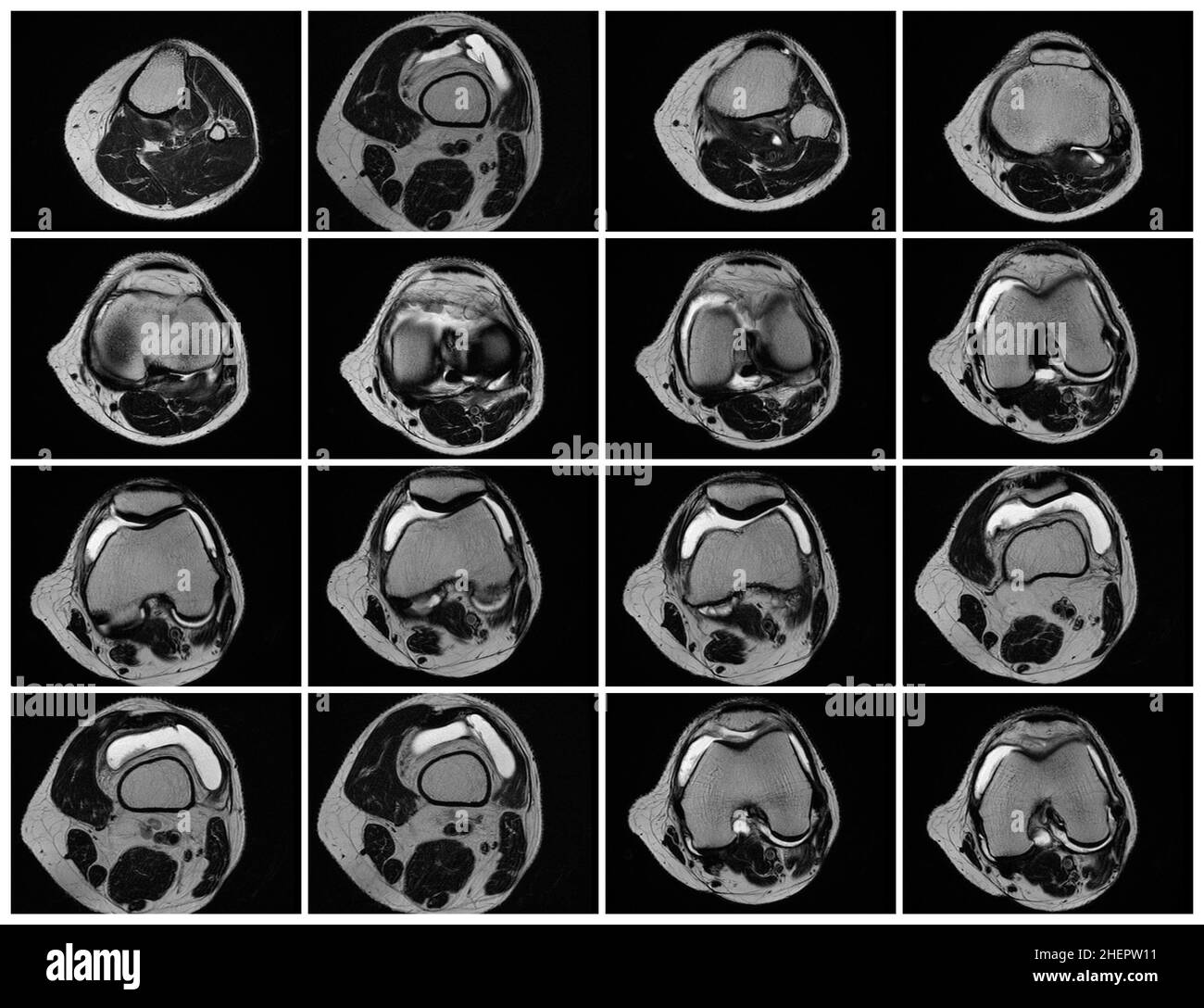 Imagerie par résonance magnétique, images MRT du genou.arthrite psoriasique aiguë, arthrose .excès de liquide synovial dans et autour de l'articulation gauche du genou Banque D'Images Imagerie par résonance magnétique, images MRT du genou.arthrite psoriasique aiguë, arthrose .excès de liquide synovial dans et autour de l'articulation gauche du genou Banque D'Images