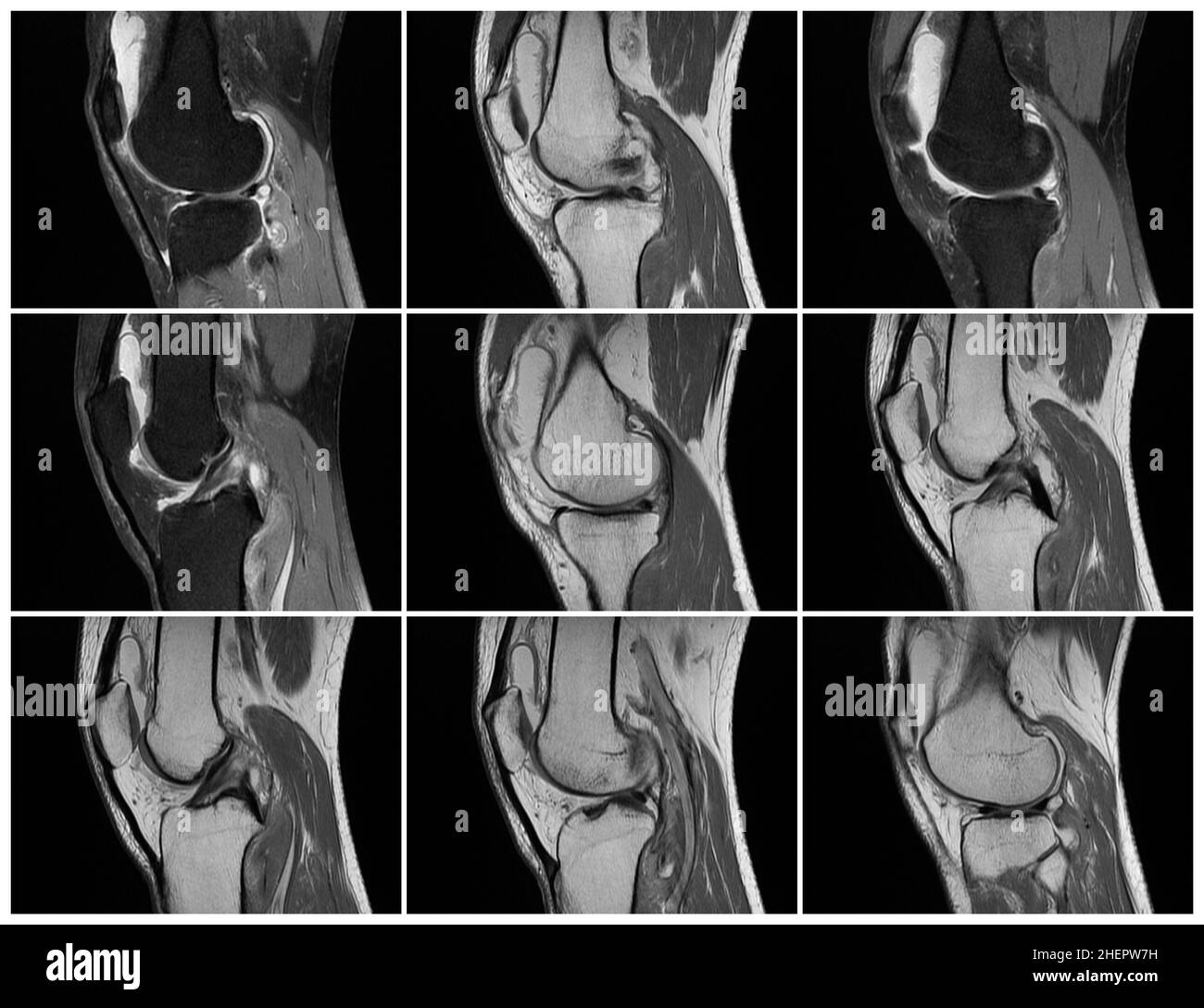 Imagerie par résonance magnétique, images MRT du genou.arthrite psoriasique aiguë, arthrose .excès de liquide synovial dans et autour de l'articulation gauche du genou Banque D'Images Imagerie par résonance magnétique, images MRT du genou.arthrite psoriasique aiguë, arthrose .excès de liquide synovial dans et autour de l'articulation gauche du genou Banque D'Images