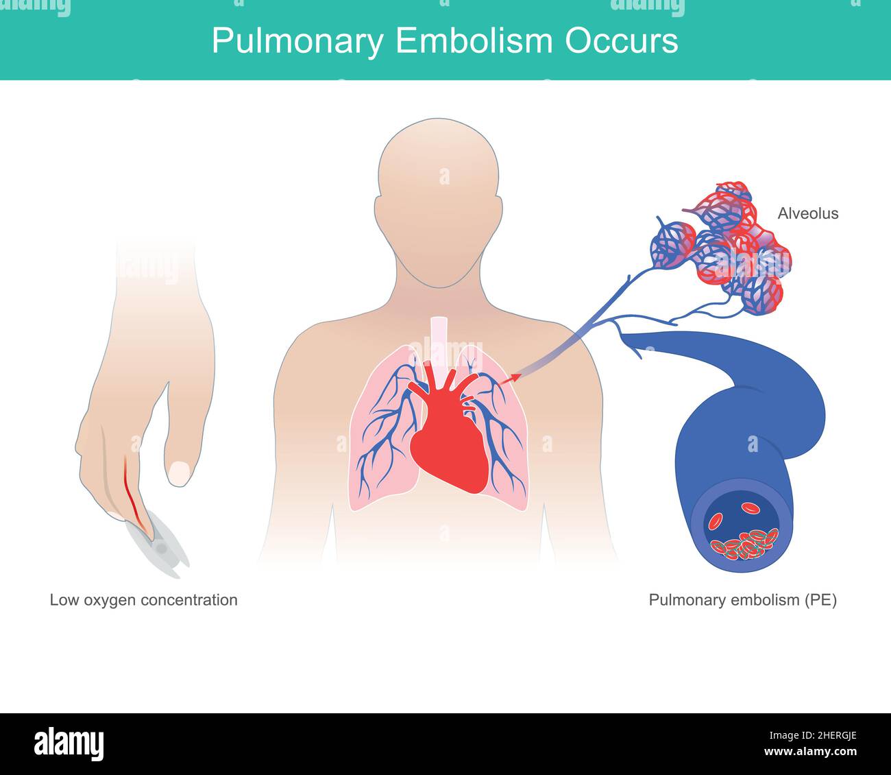 L'embolie pulmonaire se produit.Une condition anormale de faible niveau d'oxygène dans le sang, cause de l'embolie pulmonaire, se produit. Illustration de Vecteur